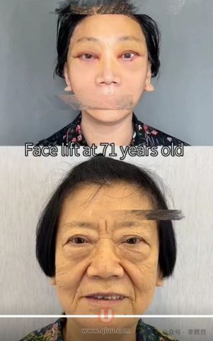 太可怕了拉皮失败对比照片