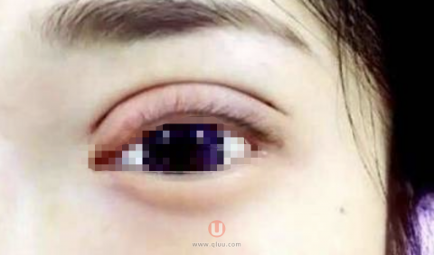 良心医生告诉你双眼皮假得非常明显怎么办