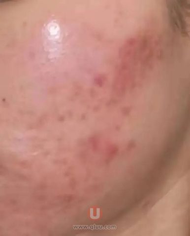 刷酸烂脸失败案例真实图片