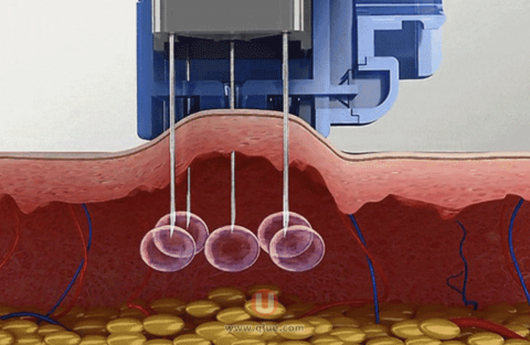 水光针的原理到底是什么？最新解读