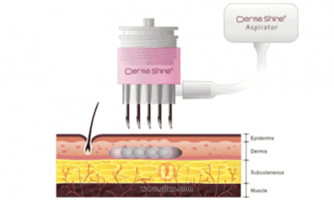 水光针是不是智商税？为什么这么神奇？