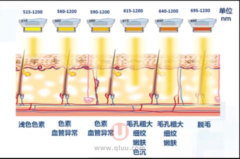 光子嫩肤是什么意思？原理是怎么样的？