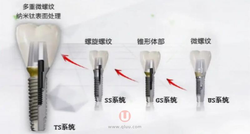 进口种植牙品牌三大“性价比之王”前三名单发布