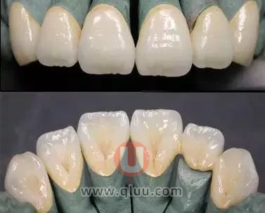 二氧化锆全瓷冠真实图片