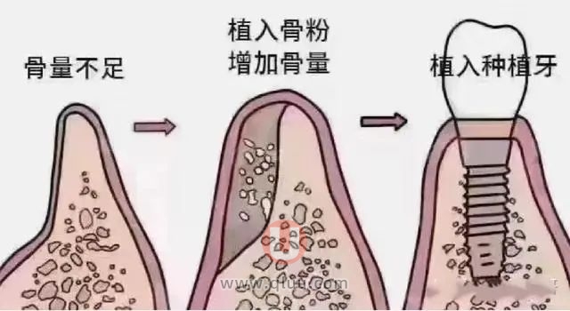 牙槽骨太少了怎么做种植牙？