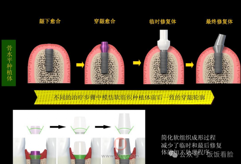 种植牙具体流程（一期二期三期）
