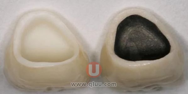 医院最热门问的最多的三大牙冠问题整理