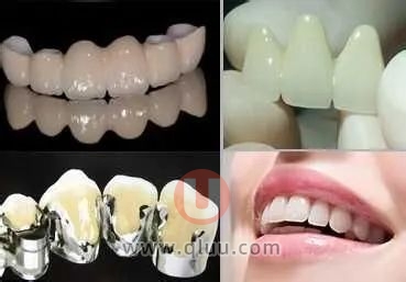 老年人烤瓷牙全瓷牙四大区别