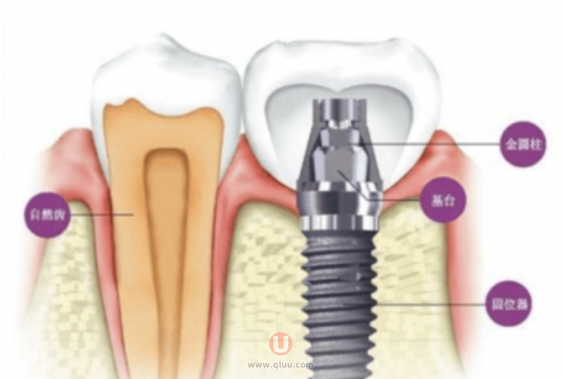 种植牙是如何进行的？对身体有危害吗？