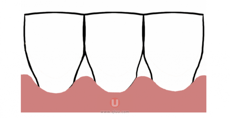 牙龈萎缩是什么样子的表现？图片来了