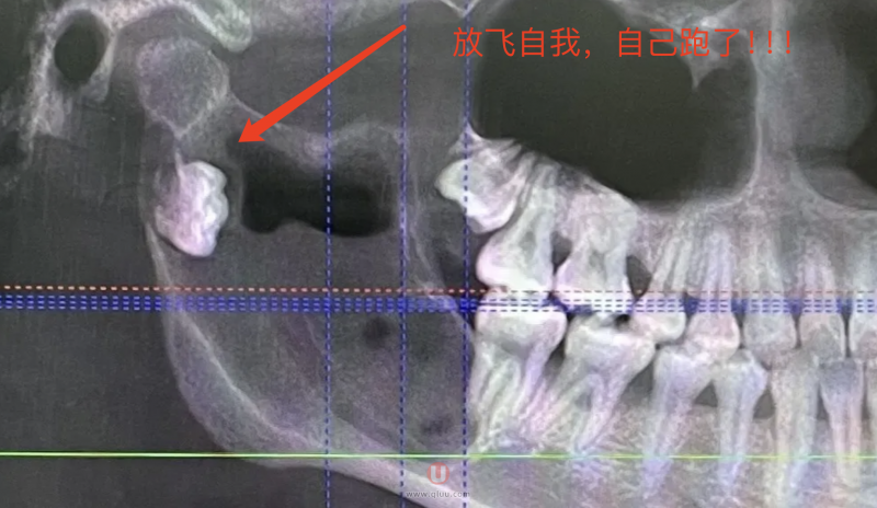 医生两个小时都拔不出来的智齿长什么样附图片