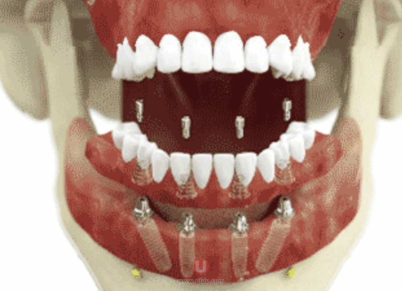 瑞士sic种植牙亲身经验分享看牙记