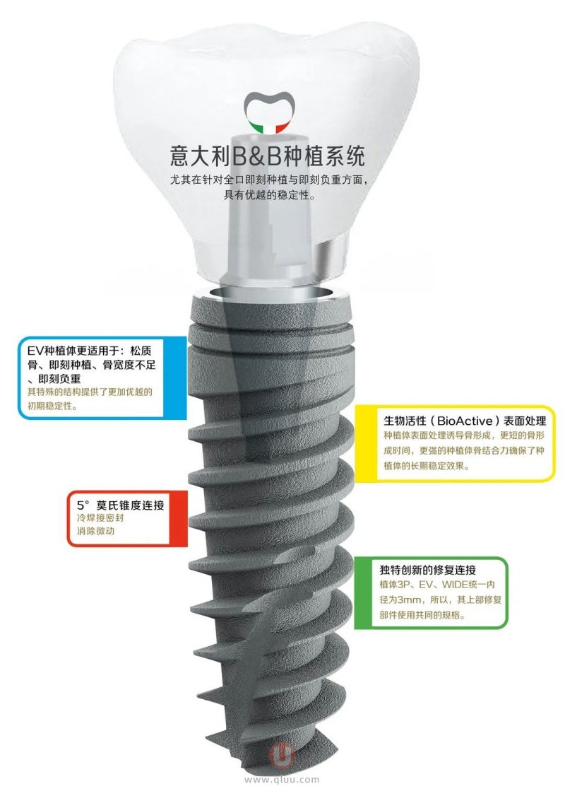 BB种植体是哪个国家的种植牙品牌？