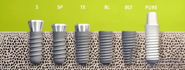 种植牙三大材质哪种最好？钛合金种植体怎么样