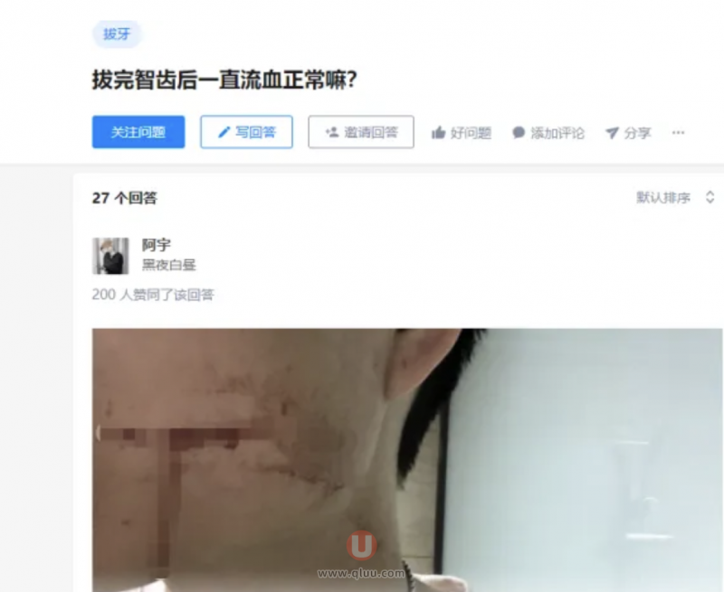 震惊！26岁男子拔智齿后流血不止导致死亡（拔牙后难以止血10多天后离世 ）