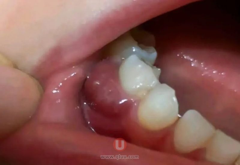 警惕！牙龈鼓脓疱真实照片来了